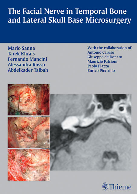 Facial Nerve in Temporal Bone and Lateral Skull Base Microsurgery, Mario Sanna, Tarek Khrais, Fernando Mancini
