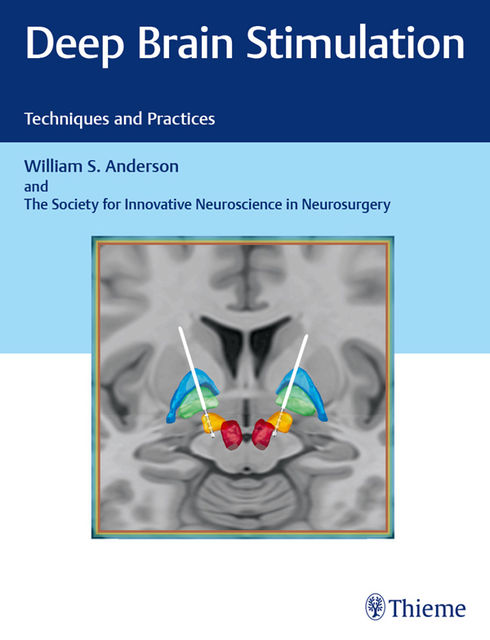 Deep Brain Stimulation, William Anderson, The Society for Innovative Neuroscience in Neurosurgery