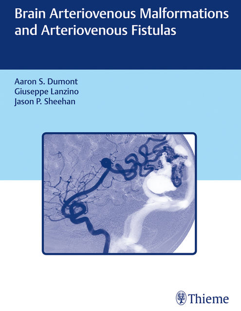Brain Arteriovenous Malformations and Arteriovenous Fistulas, Giuseppe Lanzino, Jason Sheehan, Aaron S. Dumont