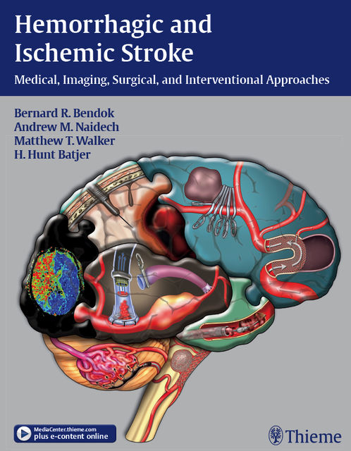 Hemorrhagic and Ischemic Stroke, H.Hunt Batjer, Andrew M.Naidech, Bernard R.Bendok, Matthew T.Walker