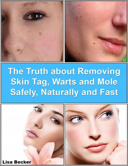 The Truth About Removing Skin Tag, Warts and Mole Safely, Naturally and Fast, Lisa Becker