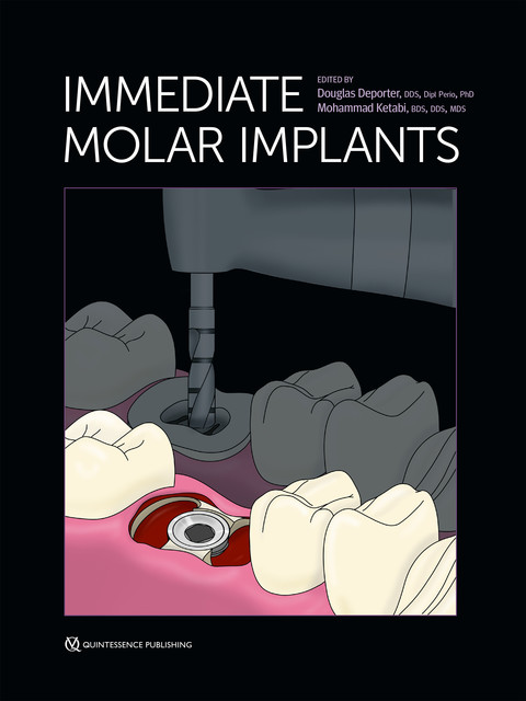 Immediate Molar Implants, Douglas Deporter, Mohammad Ketabi