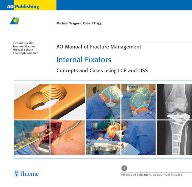 AO Manual of Fracture Management: Internal Fixators, Michael Wagner, Robert Frigg