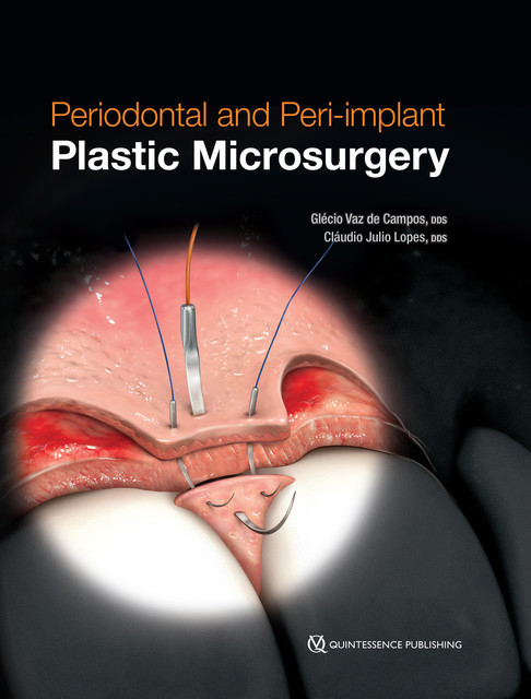 Periodontal and Peri-implant Plastic Microsurgery, Cláudio Julio Lopes, Glécio Vaz de Campos