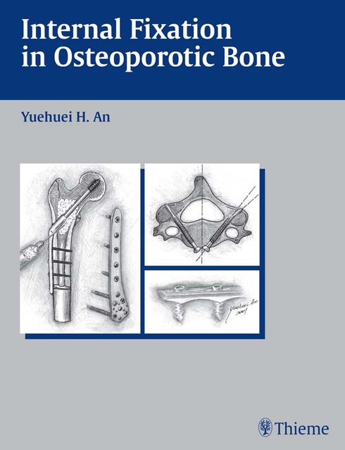Internal Fixation in Osteoporotic Bone, Yuehuei H.An