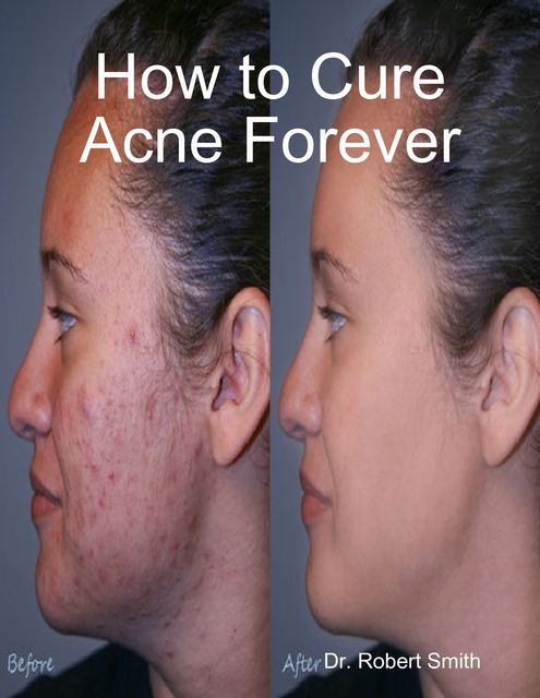 How to Cure Acne Forever, Robert Smith