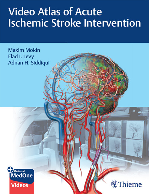Video Atlas of Acute Ischemic Stroke Intervention, Adnan H. Siddiqui, Elad I. Levy, Maxim Mokin