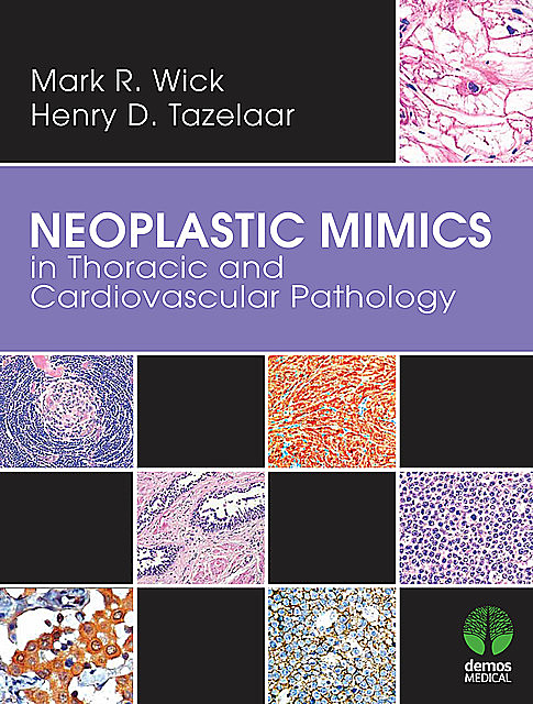 Neoplastic Mimics in Thoracic and Cardiovascular Pathology, Henry D.Tazelaar, Mark R. Wick