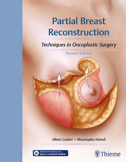 Partial Breast Reconstruction, Albert Losken, FACS Hamdi, FCCP, Moustapha Hamdi