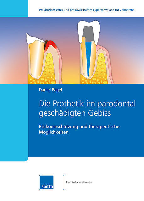 Die Prothetik im parodontal geschädigten Gebiss, Daniel Pagel