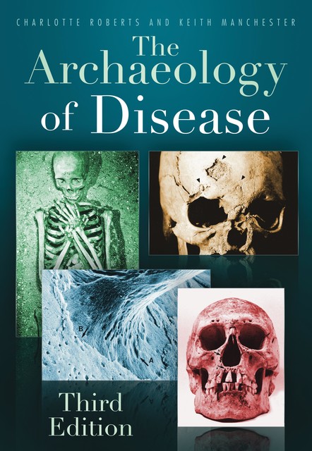 The Archaeology of Disease, Charlotte Roberts, Keith Manchester