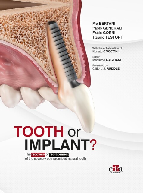 Tooth or Implant, Massimo Gagliani, Fabio Gorni, Pio Bertani, Paolo Generali, Tiziano Testori
