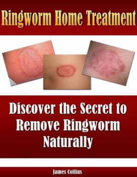 Ringworm Home Treatment: Discover the Secret to Remove Ringworm Naturally, James Collins