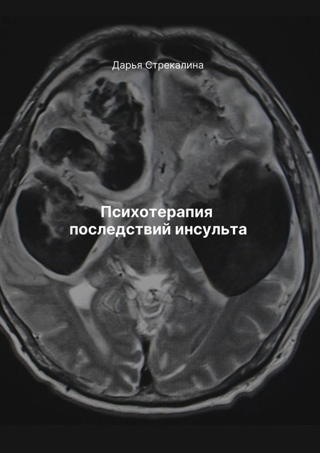 Психотерапия последствий инсульта, Дарья Стрекалина