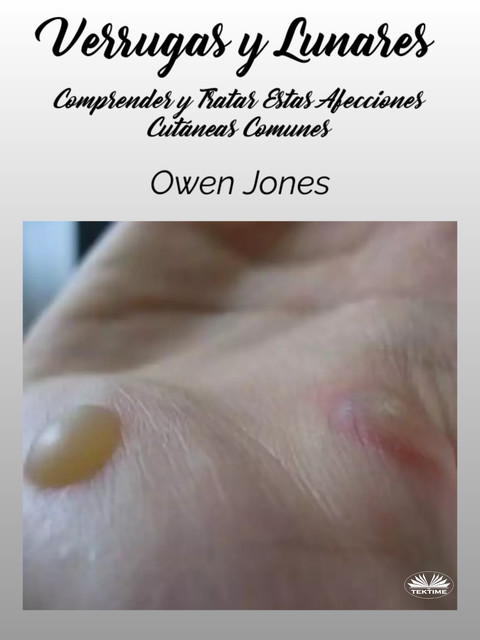Verrugas Y Lunares-Comprender Y Tratar Estas Afecciones Cutáneas Comunes, Owen Jones