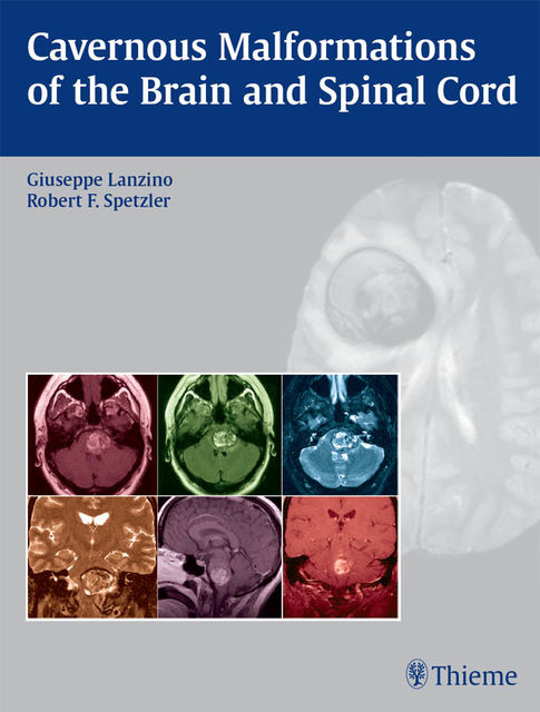Cavernous Malformations of the Brain and Spinal Cord, Giuseppe Lanzino, Robert F.Spetzler