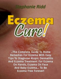 Eczema Cure!: The Complete Guide to Home Remedies for Eczema With Easy Tips to Diagnose Atopic Dermatitis and Eczema Treatment for Eczema On Hands, Eczema On Face and Baby Eczema… to Be Eczema Free Forever, Stephanie Ridd