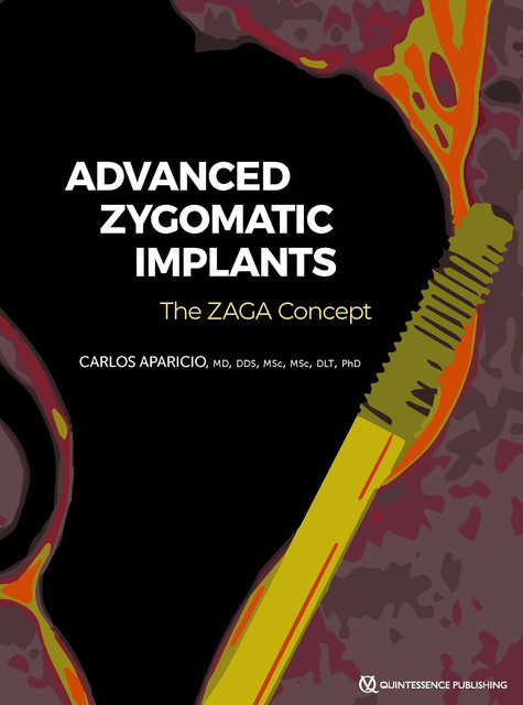 Zygomatic Implants, Carlos Aparicio