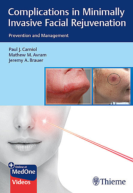 Complications in Minimally Invasive Facial Rejuvenation, Paul J.Carniol, Jeremy A. Brauer, Mathew M. Avram