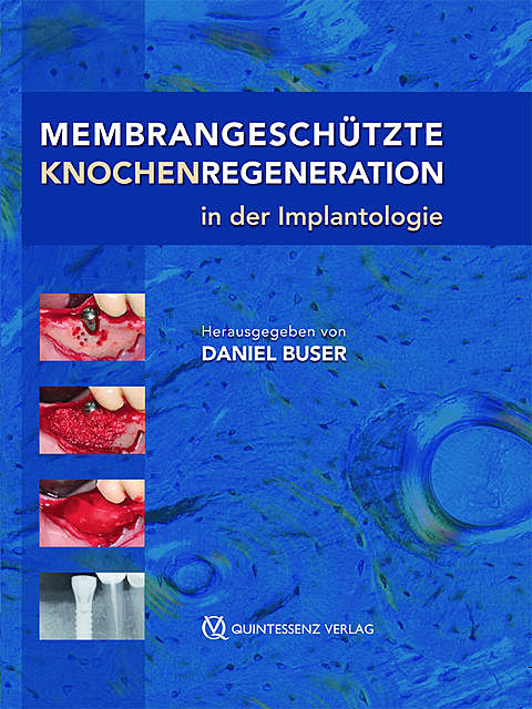 Membrangeschützte Knochenregeneration in der Implantologie, Daniel Buser