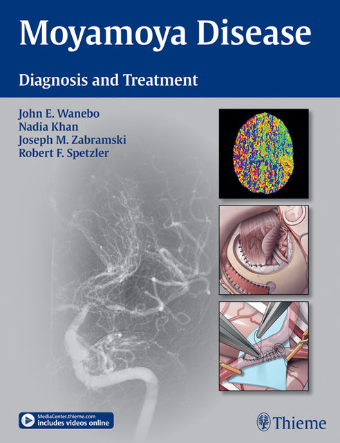 Moyamoya Disease, Nadia Khan, Robert F.Spetzler, John E.Wanebo, Joseph M.Zabramski