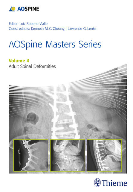 AOSpine Masters Series, Volume 4: Adult Spinal Deformities, Luiz Roberto Vialle