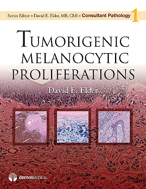 Tumorigenic Melanocytic Proliferations, David Elder, ChB, MB