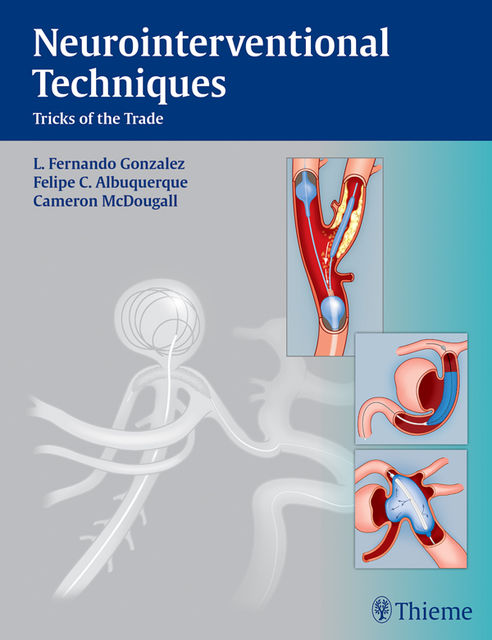 Neurointerventional Techniques, Cameron G.McDougall, Felipe C.Albuquerque, L.Fernando Gonzalez