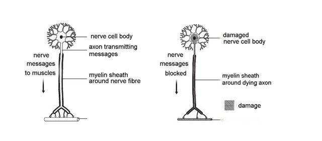 Motor Neurone Disease – Essentials, Frank Clifford Rose, Stuart Neilson