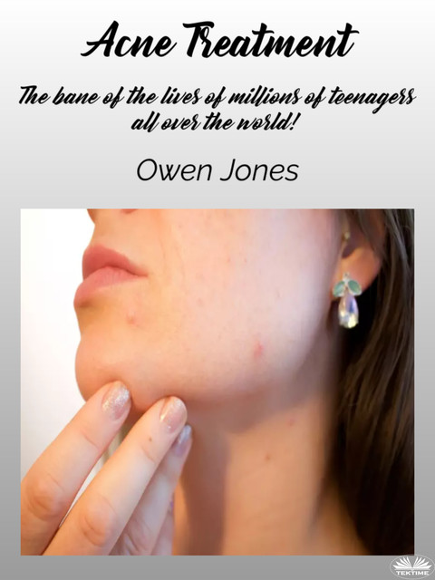Acne Treatment-The Bane Of The Lives Of Millions Of Teenagers All Over The World, Owen Jones