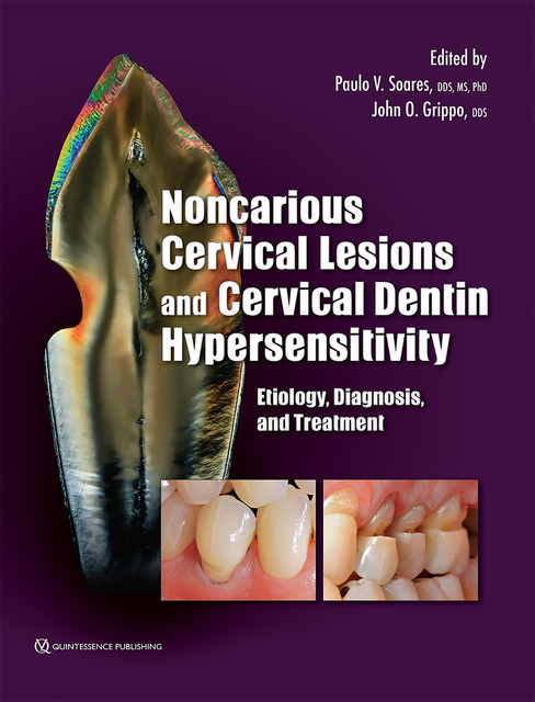 Noncarious Cervical Lesions and Cervical Dentin Hypersensitivity, John O. Grippo, Paulo V. Soares