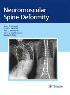 Neuromuscular Spine Deformity, Peter O.Newton, Randal R.Betz, Paul D.Sponseller, Harry L.Shufflebarger, Amer F. Samdani