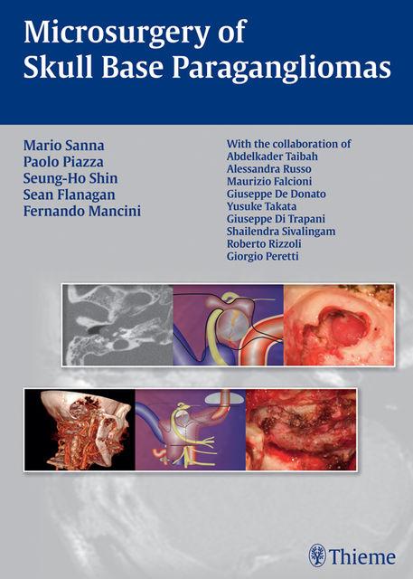 Microsurgery of Skull Base Paragangliomas, Mario Sanna, Paolo Piazza, Seung-Ho Shin
