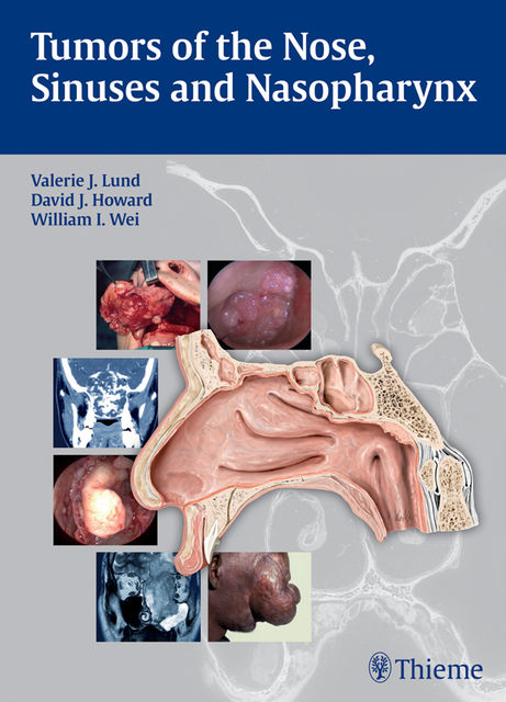 Tumors of the Nose, Sinuses and Nasopharynx, David J.Howard, Valerie J.Lund, W.I.Wei
