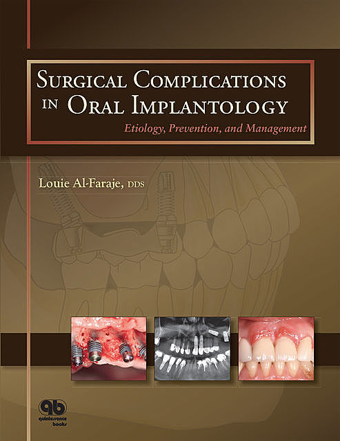 Surgical Complications in Oral Implantology, Louie Al-Faraje