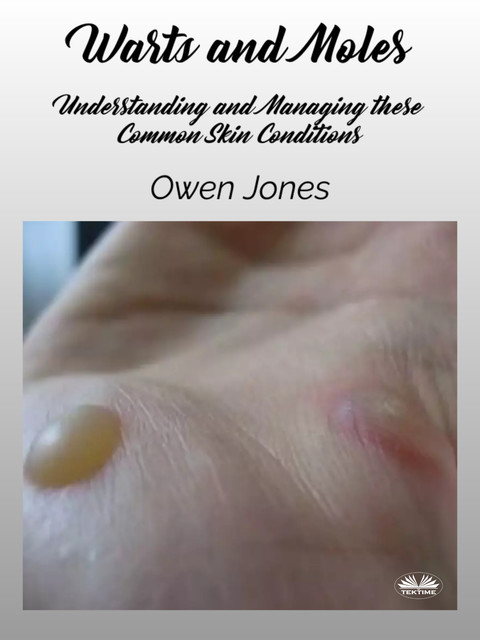 Warts And Moles-Understanding And Managing These Common Skin Conditions, Owen Jones