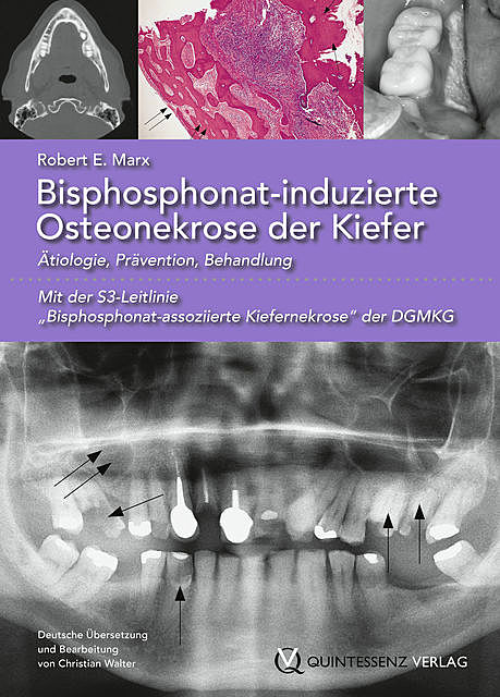 Bisphosphonat-induzierte Osteonekrose der Kiefer, Robert E. Marx