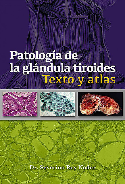 Patología de la glándula tiroides, Severino Rey Nodar