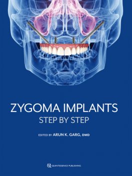 Zygoma Implants, Arun K. Garg