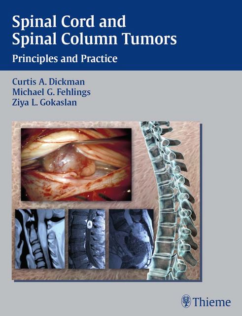 Spinal Cord and Spinal Column Tumors, Curtis A.Dickman, Michael G.Fehlings, Ziya L.Gokaslan
