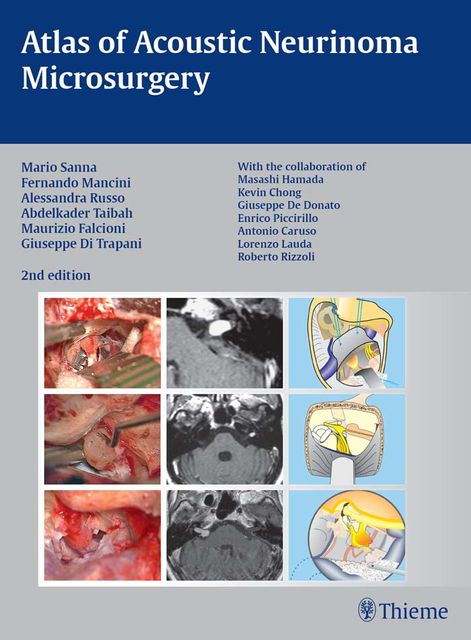Atlas of Acoustic Neurinoma Microsurgery, Mario Sanna, Fernando Mancini