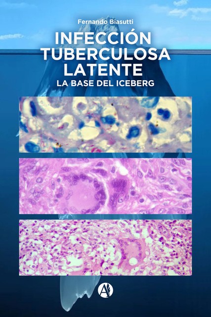 Infección Tuberculosa Latente, la base del iceberg, Fernando Biasutti