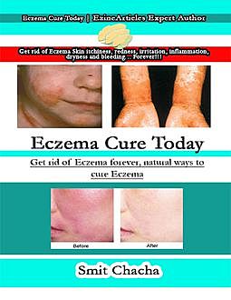 Eczema Cure Today: Get Rid of Eczema Forever, Natural Ways to Cure Eczema, Smit Chacha