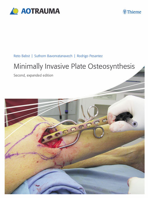 Minimally Invasive Plate Osteosynthesis (MIPO), Suthorn Bavonratanavech, Reto Babst, Rodrigo F.Pesantez