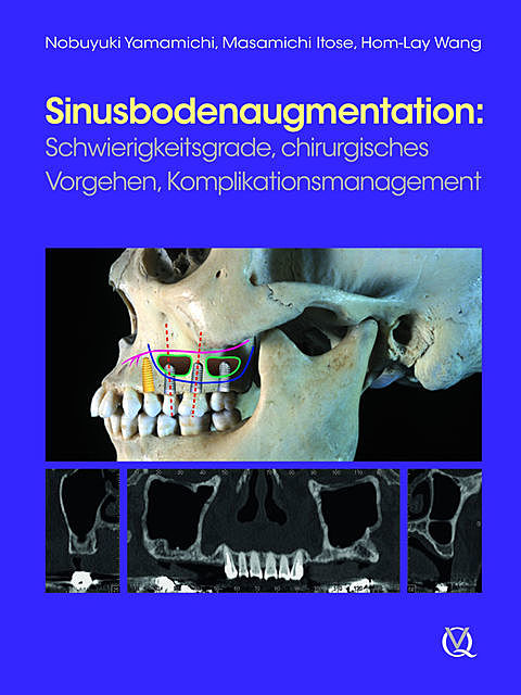 Sinusbodenaugmentation, Hom-Lay Wang, Masamichi Itose, Nobuyuki Yamamichi