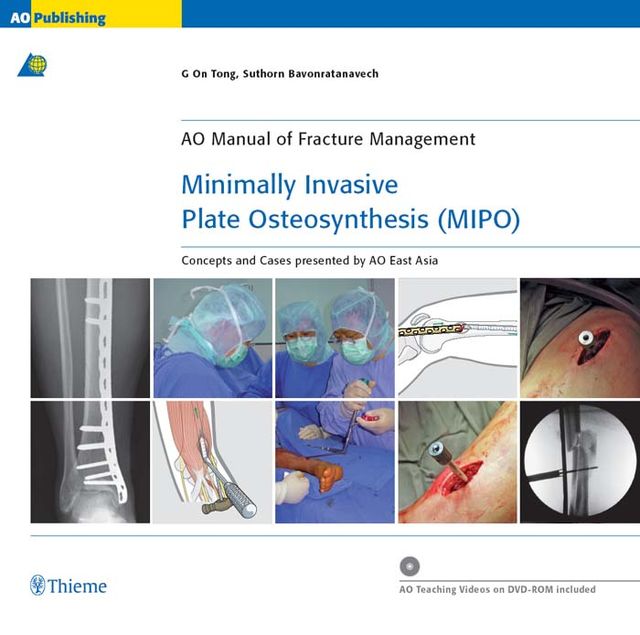 Minimally Invasive Plate Osteosynthesis (MIPO), G On Tong, Suthorn Bavonratanavech