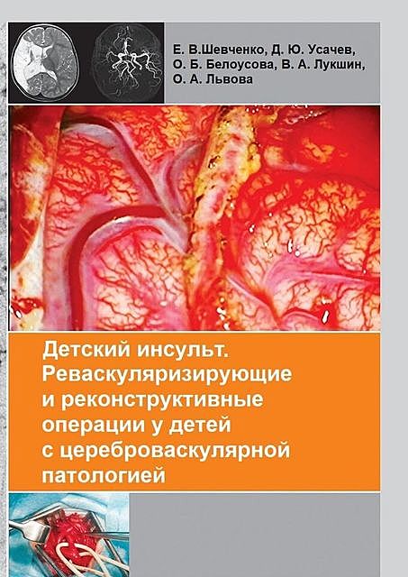 Детский инсульт. Реваскуляризирующие и реконструктивные операции у детей с цереброваскулярной патологией, О.Б. Белоусова, В.А. Лук­шин, Д.Ю. Усачев, Е.В. Шевченко, О.А. Львова